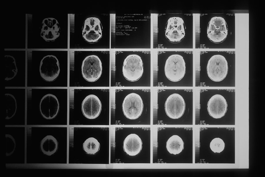 overdiagnosis ADHD